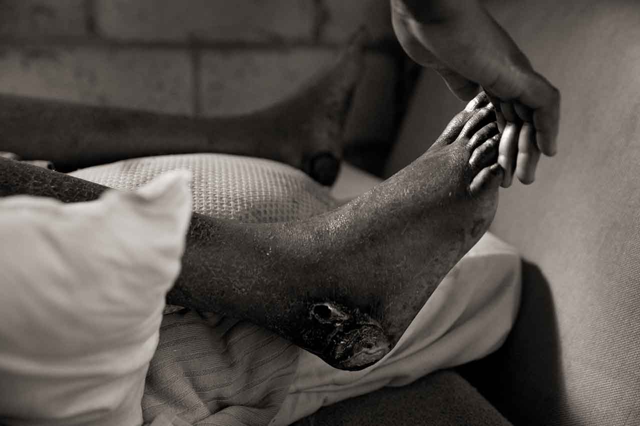 Lacieuse Timothee's sores develop gangrene after she was buried under debris for hours when Hurricane Dorian hit the Bahamas on Sept. 30, 2019. Timothee lays partly paralyzed but cannot afford to buy medication or get treatment; she was turned out from the local hospital after a few days, and was told there was nothing more to be done for her. She died three months later. The Timothee family lived with China Laguerre in Nassau; the family barely surviving on the food stamps provided by the Bahamian government. Laguerre hosted 10 people from four families who had no where to live as shelters were overflowing and other shelters turned people out.