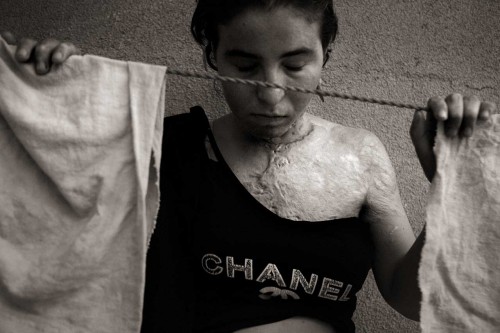 “I thought, this is my death.” Iman Eaziden Bakr, 17, raised her chin defiantly, her eyes glistening in the dim light. “I felt like a chicken being roasted. I will never forget the torture of my skin; it was so painful—as if my insides were being exposed.” Her tea had long ago gone cold as she recounted the day on January 14, 2007 when she poured kerosene on her body and set herself on fire. She had hoped that her act of sacrifice would bring peace to her family whom she described as contentious. Portrait of young Iraqi woman wearing a Chanel shirt stands with eyes closed as she shows the scars from self-immolation.
